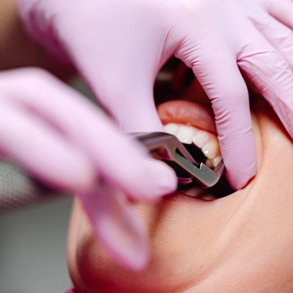 Dental model with teeth braces at CentreForTeeth