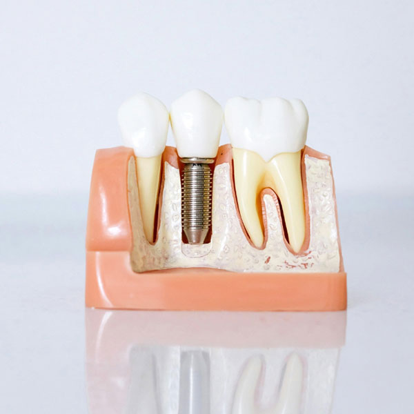 Dental implant model showing a tooth replacement