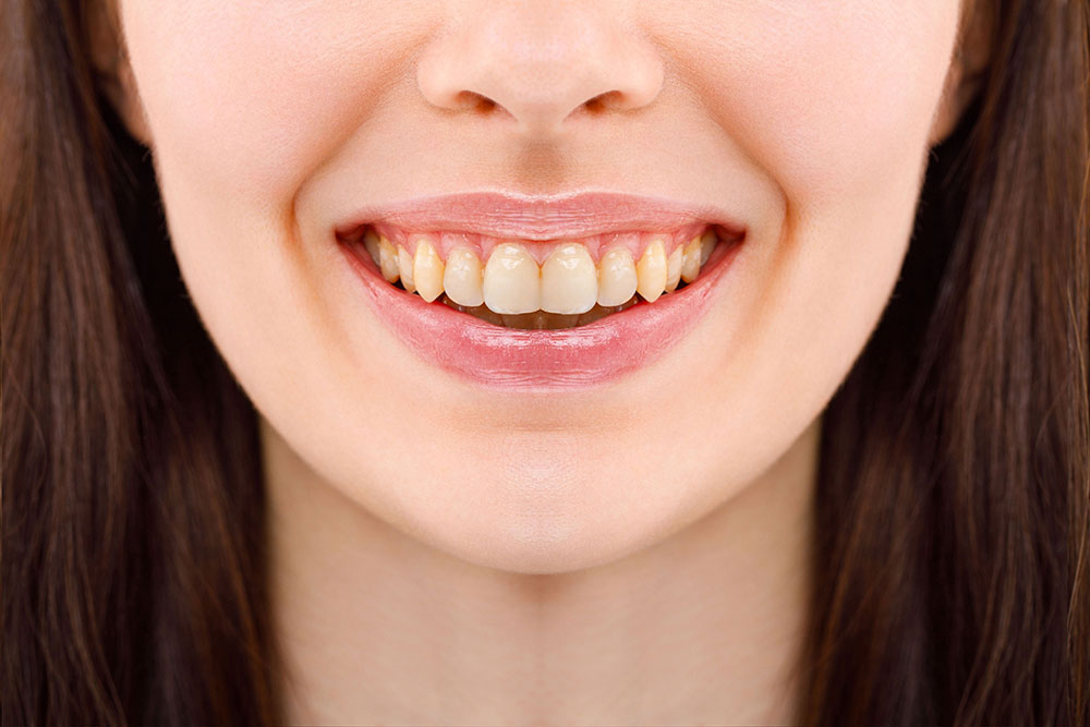 Before and after smile showing cosmetic dental results