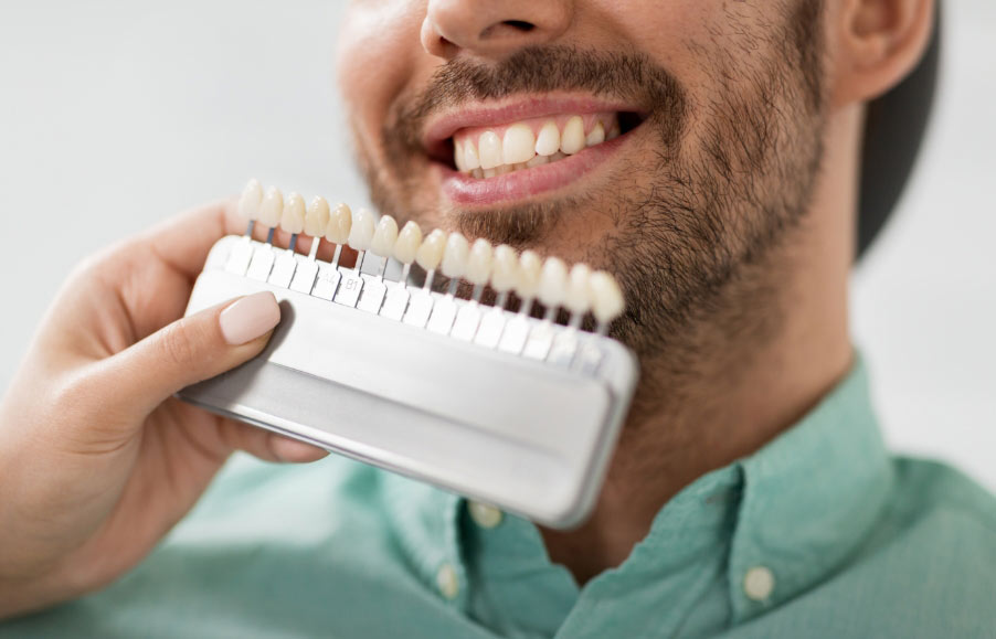 Model showing different shades of teeth for whitening treatments